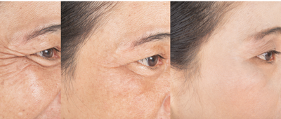 LED LIGHT THERAPY FOR REVITALIZING DULL, AGING SKIN