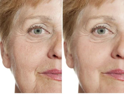 LED LIGHT THERAPY FOR DIMINISHING CROW'S FEET AND EXPRESSION LINES