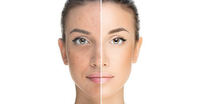 LED LIGHT THERAPY FOR ACNE AND ITS IMPACT ON SKIN TONE